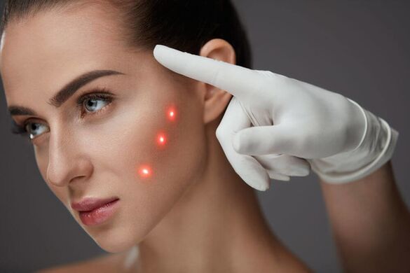 Ringiovanimento del viso laser