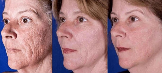 Risultato dopo la procedura di ringiovanimento della pelle del viso con il laser