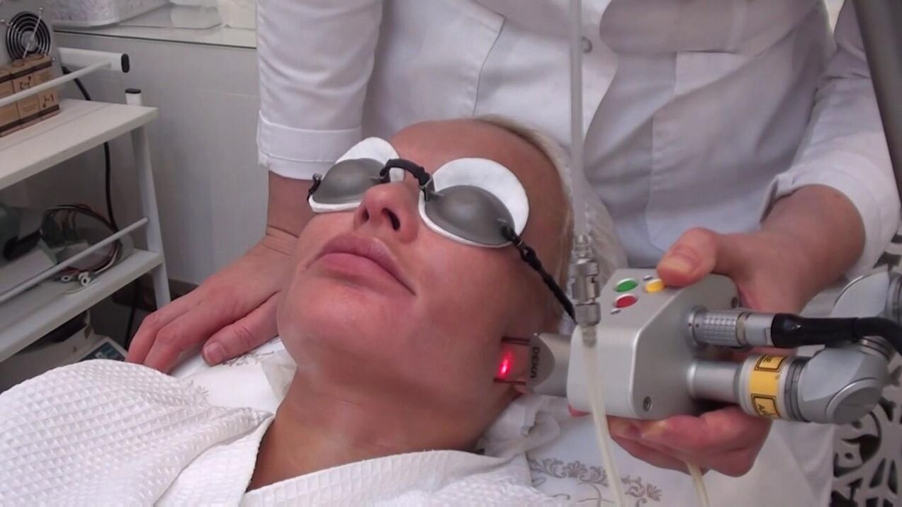 Trattamento con raggio laser delle aree problematiche della pelle del viso