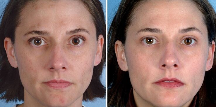 prima e dopo il ringiovanimento della pelle con il dispositivo